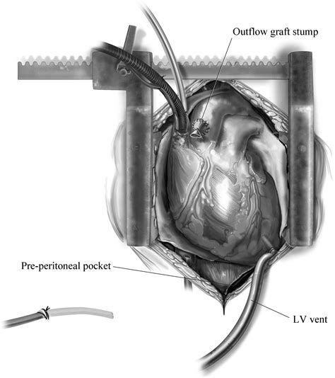 lv vent|Lv vent surgery.